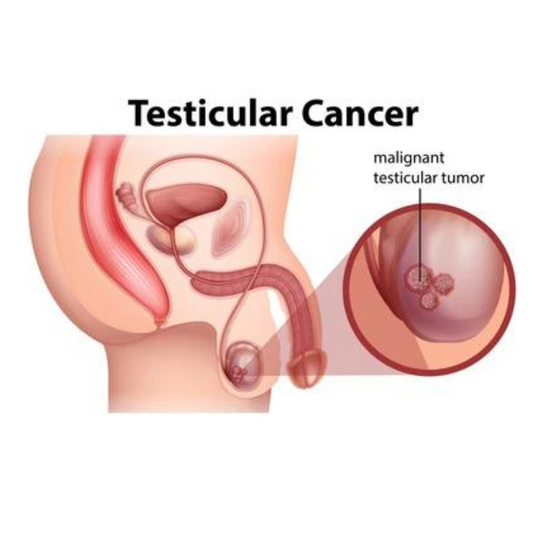 Testicular Cancer – Symptoms, Causes, Treatment