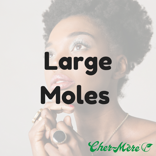 Large Mole Removal - Cher-Mere